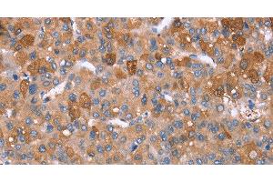 Immunohistochemistry of paraffin-embedded Human liver cancer tissue using GPC6 Polyclonal Antibody at dilution 1:40 (Glypican 6 Antikörper)
