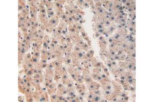 IHC-P analysis of Human Liver Cancer Tissue, with DAB staining. (CHI3L1 Antikörper  (AA 112-377))