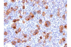 Formalin-fixed, paraffin-embedded human Hodgkin's Lymphoma stained with CD30 Mouse Recombinant Monoclonal Antibody (rKi-1/779). (Rekombinanter TNFRSF8 Antikörper)
