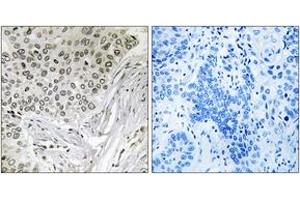 Immunohistochemistry analysis of paraffin-embedded human lung carcinoma tissue, using EFTUD2 Antibody. (EFTUD2 Antikörper  (AA 321-370))