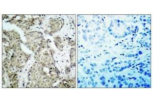 Immunohistochemical analysis of paraffin- embedded human breast carcinoma tissue using MKK6(Phospho-Ser207) Antibody(left) or the same antibody preincubated with blocking peptide(right). (MAP2K6 Antikörper  (pSer207))