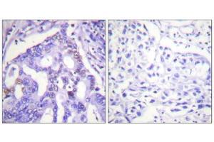 Immunohistochemistry analysis of paraffin-embedded human lung carcinoma tissue using PIAS4 antibody. (PIAS4 Antikörper  (C-Term))