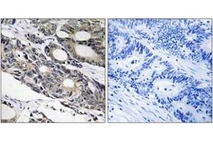 Immunohistochemistry analysis of paraffin-embedded human colon carcinoma tissue, using BCL10 Antibody. (BCL10 Antikörper  (AA 111-160))