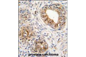 Formalin-fixed and paraffin-embedded human prostata carcinoma tissue reacted with PTGS1 antibody , which was peroxidase-conjugated to the secondary antibody, followed by DAB staining. (PTGS1 Antikörper  (C-Term))