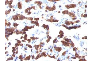 Formalin-fixed, paraffin-embedded human Thyroid Carcinoma stained Thyroglobulin Mouse Monoclonal Antibody (TGB24). (Thyroglobulin Antikörper)