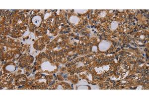 Immunohistochemistry of paraffin-embedded Human thyroid cancer tissue using PARP8 Polyclonal Antibody at dilution 1:40 (PARP8 Antikörper)