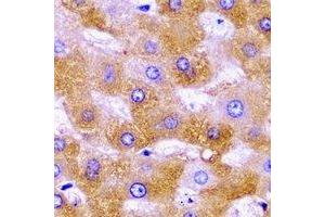 Immunohistochemical analysis of SHMT2 staining in human liver cancer formalin fixed paraffin embedded tissue section. (SHMT2 Antikörper)