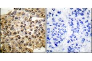 Immunohistochemistry analysis of paraffin-embedded human breast carcinoma tissue, using p44/42 MAPK Antibody. (ERK1/2 Antikörper  (AA 330-379))