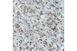Immunohistochemical staining (Formalin-fixed paraffin-embedded sections) of human breast cancer with BRD4 monoclonal antibody, clone CL1115  shows moderate nuclear immunoreactivity in tumor cells. (BRD4 Antikörper)