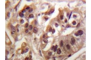Immunohistochemistry analyzes of IKKγ antibody in paraffin-embedded human breast carcinoma tissue. (IKBKG Antikörper)