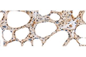 Immunohistochemistry of paraffin-embedded Human thyroid cancer tissue using RAB11A Polyclonal Antibody at dilution of 1:35(x200) (RAB11A Antikörper)