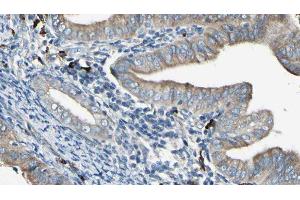 ABIN6277956 at 1/100 staining Human cervical cancer tissue by IHC-P. (SOAT1 Antikörper  (Internal Region))