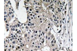 Immunohistochemistry analyzes of Caspase-7 antibody in paraffin-embedded human breast carcinoma tissue. (Caspase 7 Antikörper)