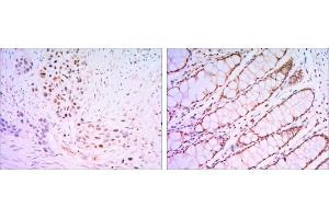 Immunohistochemical analysis of paraffin-embedded lung cancer tissues (left) and human rectum tissues (right) using KLF4 antibody with DAB staining.
