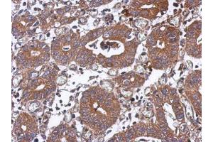 IHC-P Image Immunohistochemical analysis of paraffin-embedded human colon carcinoma, using PPM1J, antibody at 1:500 dilution. (PPM1J Antikörper)