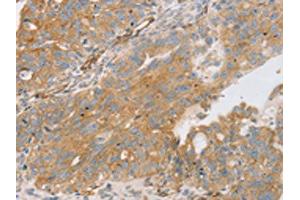 The image on the left is immunohistochemistry of paraffin-embedded Human breast cancer tissue using ABIN7131237(STX16 Antibody) at dilution 1/30, on the right is treated with fusion protein. (Syntaxin 16 Antikörper)