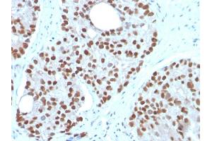 Formalin-fixed, paraffin-embedded human Prostate Carcinoma stained with NKX3. (NKX3-1 Antikörper  (AA 92-224))