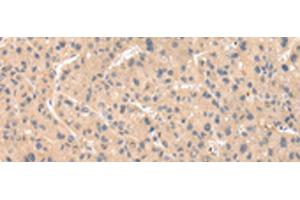 Immunohistochemistry of paraffin-embedded Human liver cancer tissue using ZNF268 Polyclonal Antibody at dilution of 1:50(x200) (ZNF268 Antikörper)