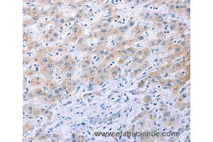 Immunohistochemistry of Human thyroid cancer using FGF4 Polyclonal Antibody at dilution of 1:40 (FGF4 Antikörper)
