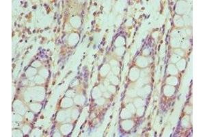 Immunohistochemistry of paraffin-embedded human colon cancer using ABIN7156622 at dilution of 1:100 (IRF4 Antikörper  (AA 180-451))