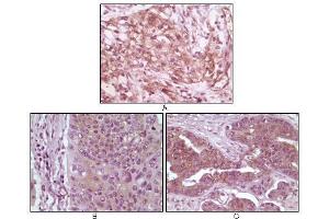 Immunohistochemical analysis of paraffin-embedded human pancreas carcinoma (A), esophagus carcinoma tissue (B) and ovary tumor tissue, showing cytoplasmic and membrane localization using 4E-BP1 mouse mAb with DAB staining. (eIF4EBP1 Antikörper)