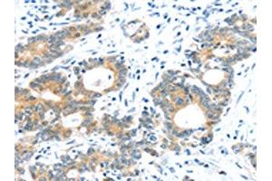 The image on the left is immunohistochemistry of paraffin-embedded Human colorectal cancer tissue using ABIN7192957(TUSC1 Antibody) at dilution 1/30, on the right is treated with synthetic peptide. (TUSC1 Antikörper)