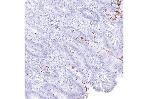 Abundant helicobacter pylori in a case of gastritis (Helicobacter Pylori Antikörper  (AA 323-445))