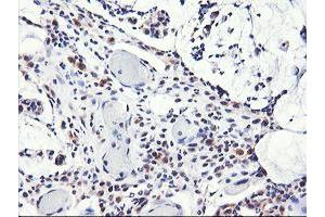 Immunohistochemical staining of paraffin-embedded Adenocarcinoma of Human colon tissue using anti-NLN mouse monoclonal antibody. (NLN Antikörper)