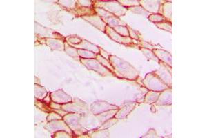 Immunohistochemical analysis of Paxillin staining in human breast cancer formalin fixed paraffin embedded tissue section. (Paxillin Antikörper  (Center))