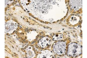 DRP1 Mouse Monoclonal Antibody at 1/100 staining human ovarian cancer by IHC-P.