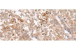Immunohistochemistry of paraffin-embedded Human ovarian cancer tissue using MCAM Polyclonal Antibody at dilution of 1:40(x200) (MCAM Antikörper)