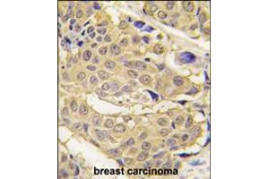 Formalin-fixed and paraffin-embedded human breast carcinoma tissue reacted with EPRS antibody , which was peroxidase-conjugated to the secondary antibody, followed by DAB staining.