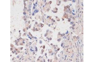 Immunohistochemistry of paraffin-embedded Human lung cancer using HTATSF1 Polyclonal Antibody at dilution of 1:100 (40x lens). (HTATSF1 Antikörper)