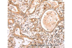 Immunohistochemistry of Human liver cancer using ABCF1 Polyclonal Antibody at dilution of 1:40 (ABCF1 Antikörper)