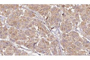 ABIN6276604 at 1/100 staining Human Melanoma tissue by IHC-P. (LCN6 Antikörper  (Internal Region))