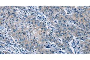 Immunohistochemistry of paraffin-embedded Human gastric cancer tissue using GAS2 Polyclonal Antibody at dilution 1:50 (GAS2 Antikörper)