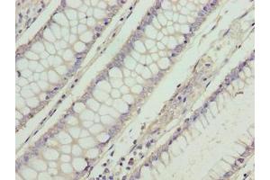 Immunohistochemistry of paraffin-embedded human colon cancer using ABIN7166002 at dilution of 1:100 (RD3 Antikörper  (AA 1-195))