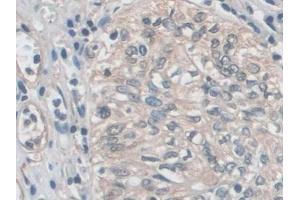 Detection of EZR in Human Prostate cancer Tissue using Polyclonal Antibody to Ezrin (EZR)