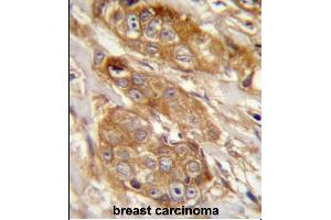 GRINA Antibody (Center) (ABIN657481 and ABIN2846508) immunohistochemistry analysis in formalin fixed and paraffin embedded human breast carcinoma followed by peroxidase conjugation of the secondary antibody and DAB staining. (GRINA Antikörper  (AA 131-158))