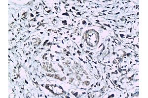 Formalin-fixed and paraffin embedded human colorectal cancer labeled with Anti-phospho-KLF5(Ser275) Polyclonal Antibody, Unconjugated (ABIN676778) followed by conjugation to the secondary antibody and DAB staining (KLF5 Antikörper  (pSer275))