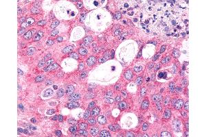 Anti-FZD6 / Frizzled 6 antibody IHC of human Lung, Non-Small Cell Carcinoma. (FZD6 Antikörper  (N-Term))