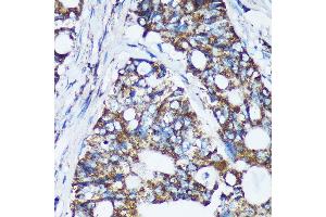 Immunohistochemistry of paraffin-embedded Human colon carcinoma using CDKL3 Rabbit pAb (ABIN7266612) at dilution of 1:100 (40x lens). (CDKL3 Antikörper  (AA 1-120))