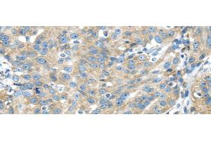 Immunohistochemistry of paraffin-embedded Human breast cancer using TXNDC5 Polyclonal Antibody at dilution of 1/40 (TXNDC5 Antikörper)