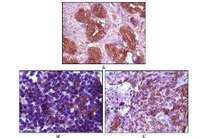 Immunohistochemical analysis of paraffin-embedded human breast tissue (A), lymph tissue (B) and skin carcinoma (C), showing membrane localization using BLK mouse mAb with DAB staining. (BLK Antikörper)