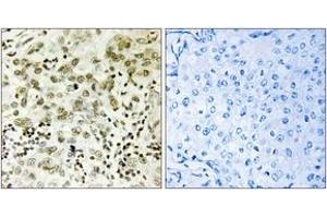 Immunohistochemistry analysis of paraffin-embedded human breast carcinoma tissue, using CTDSP1 Antibody. (CTDSP1 Antikörper  (AA 1-50))