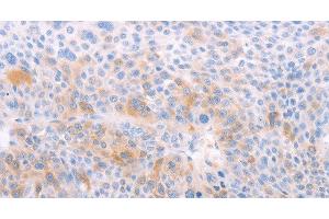 Immunohistochemistry of paraffin-embedded Human liver cancer using EDG6 Polyclonal Antibody at dilution of 1:40 (S1PR4 Antikörper)