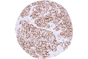 Invasive breast cancer of no special type NST with distinct SOX10 positivity of tumor cells