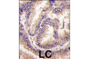 Formalin-fixed and paraffin-embedded human lung carcinoma tissue reacted with CDKL5 polyclonal antibody  , which was peroxidase-conjugated to the secondary antibody, followed by DAB staining. (CDKL5 Antikörper  (C-Term))