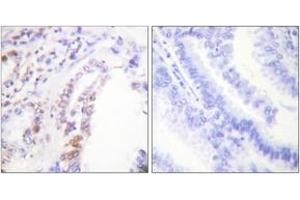 Immunohistochemistry analysis of paraffin-embedded human lung carcinoma tissue, using AML1 (Ab-303) Antibody. (RUNX1 Antikörper  (AA 269-318))
