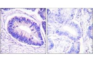 Immunohistochemistry analysis of paraffin-embedded human colon carcinoma, using MYPT1 (Phospho-Thr853) Antibody. (PPP1R12A Antikörper  (pThr853))